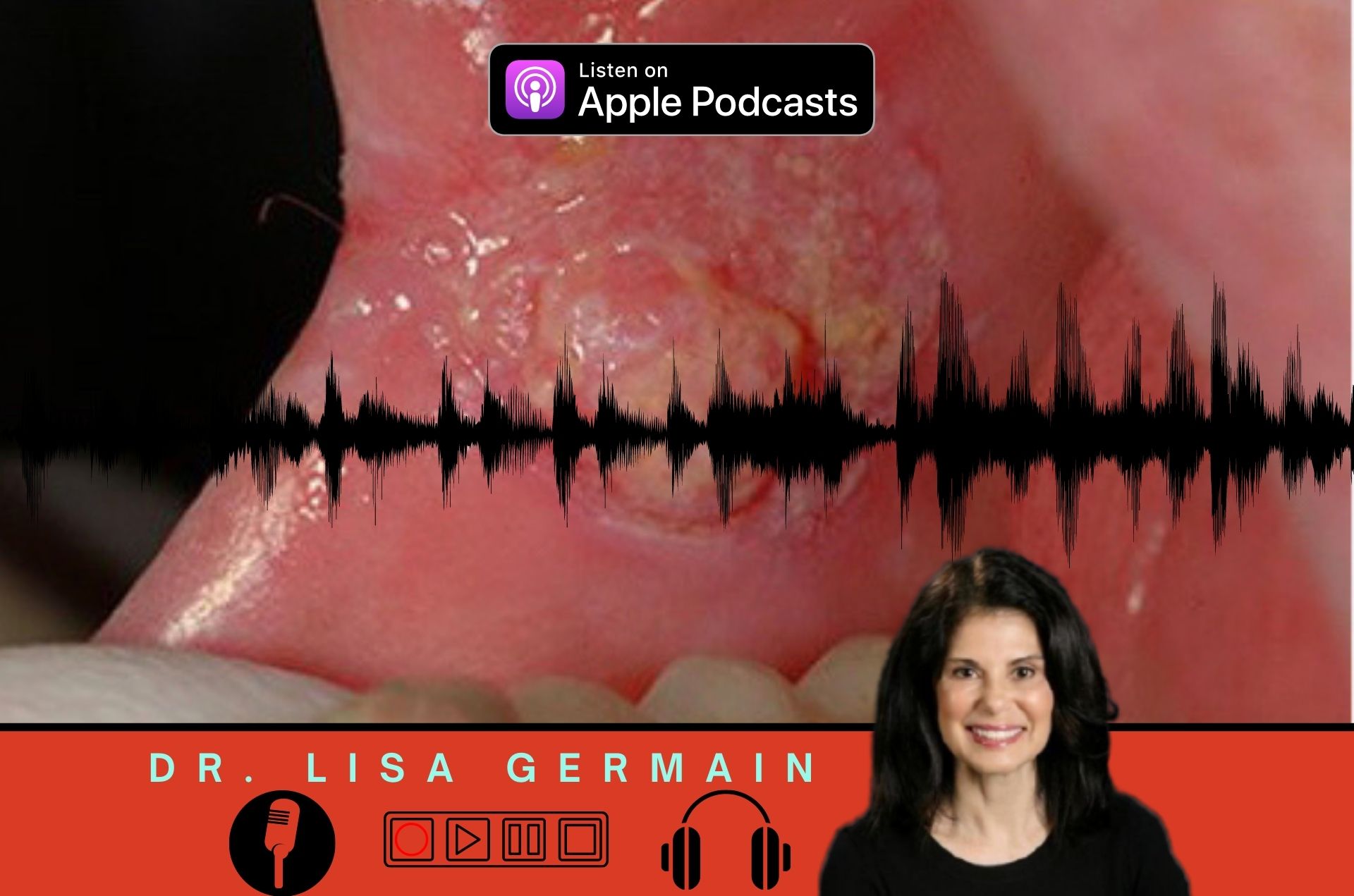 Oral Cancer Causes podcast by Dr. Lisa Germain